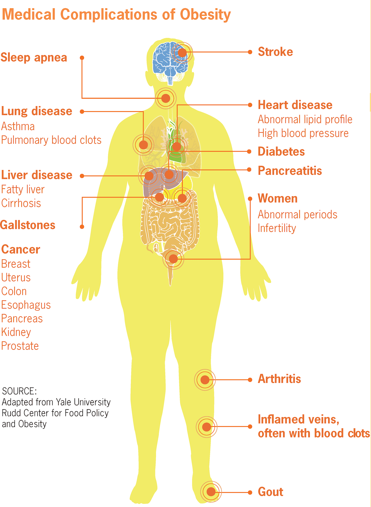 Sleep apnea is commonly linked with obesity and can be treated with CPAP therapy.